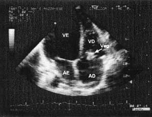 vegetacion endocardica