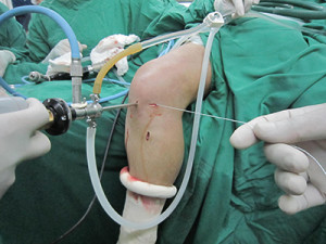 sutura ultrabraid