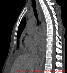 tem PERICARDITIS (Cópia)