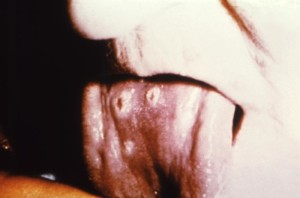 Esta fotografia 1962 mostrava a língua de um paciente contra a varíola , em Cardiff , País de Gales , durante uma epidemia. Estas lesões foram determinados para ser benignos , erupções da varíola semi- confluentes focais, que foram dois dias de duração uma erupção aparece em primeiro lugar como pequenas manchas vermelhas na língua e na boca. Uma erupção em seguida aparece na pele , começando no rosto e espalhando-se para os braços e pernas e depois para as mãos e pés. Normalmente, o prurido espalha para todas as partes do corpo dentro de 24 horas. Autor: CDC/ Dr. Charles Farmer, Jr - 1962. ID#: 10372.