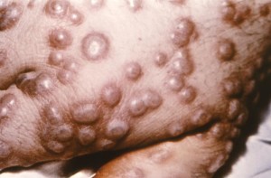 Esta fotografia mostrava um paciente varíola em Cardiff , País de Gales , durante uma epidemia de 1962. As lesões aqui em cima de sua mão direita, estavam determinados a ser benignos, semi- confluentes erupções da varíola focais. Autor: CDC/ Dr. Charles Farmer, Jr., ID#:10375