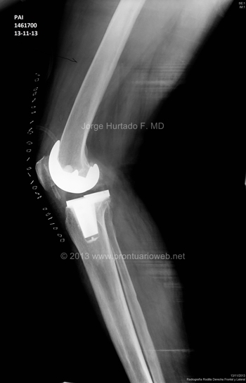 FOTO 4: PRÓTESIS TOTAL DE RODILLA - Dr. JORGE HURTADO F.