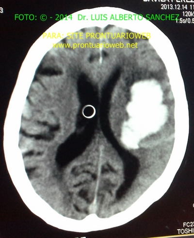 ictus hemorragico - prontuarioweb A