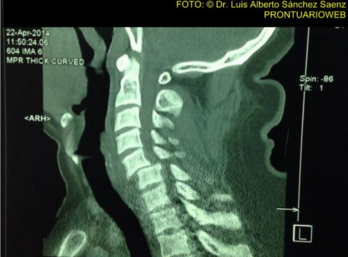 traumatismo vertebro medular - prontuarioweb