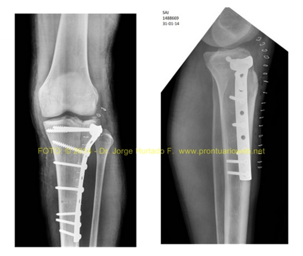 FRACTURA PLATIILLO TIBIAL