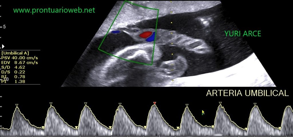 Doppler umbilical