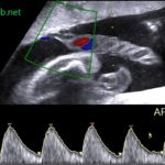 Doppler umbilical